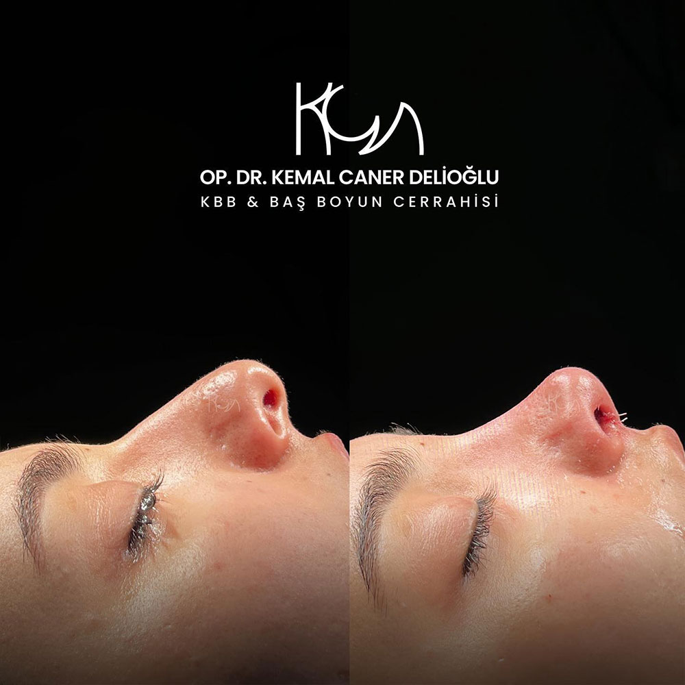 before-after