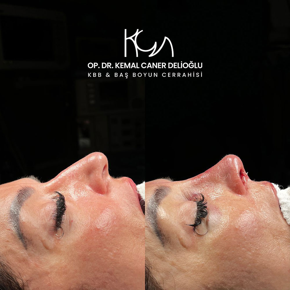 before-after