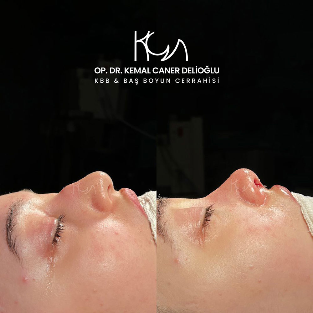 before-after