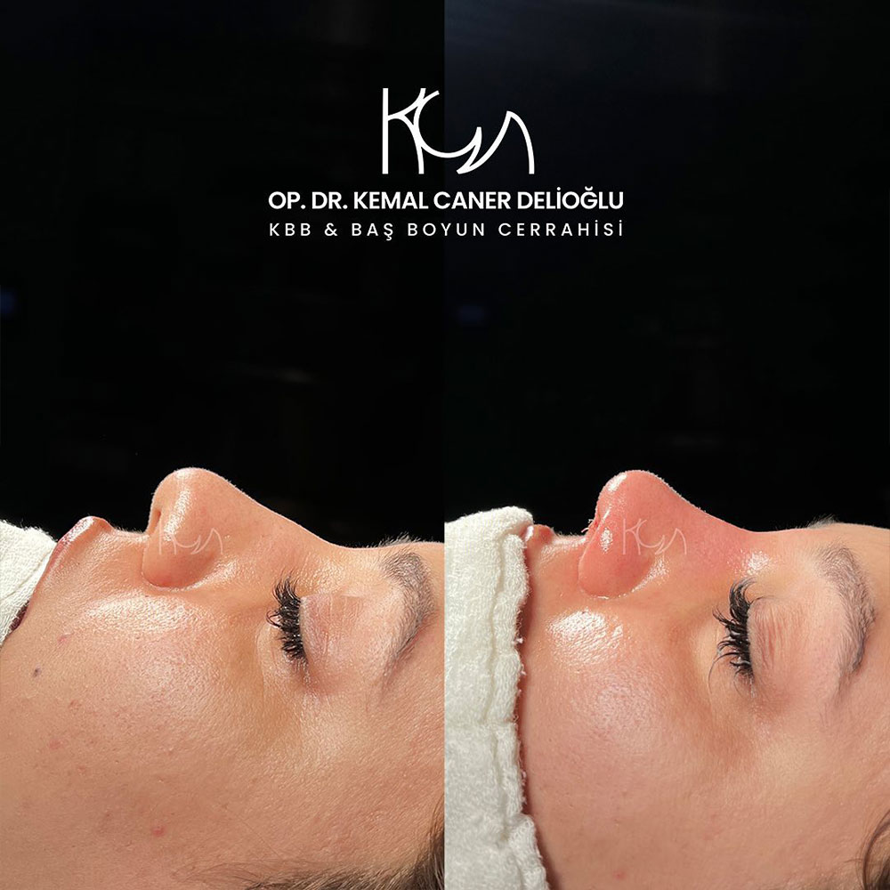 before-after