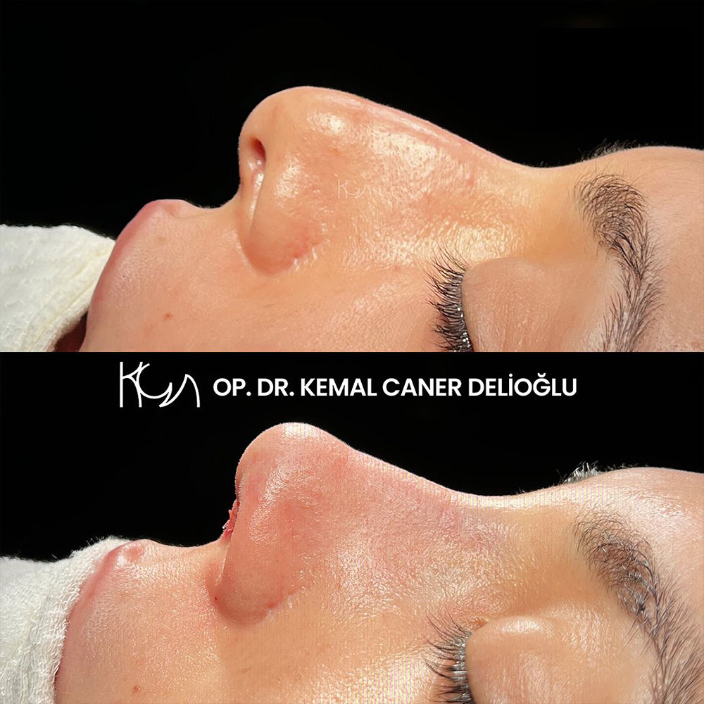 before-after