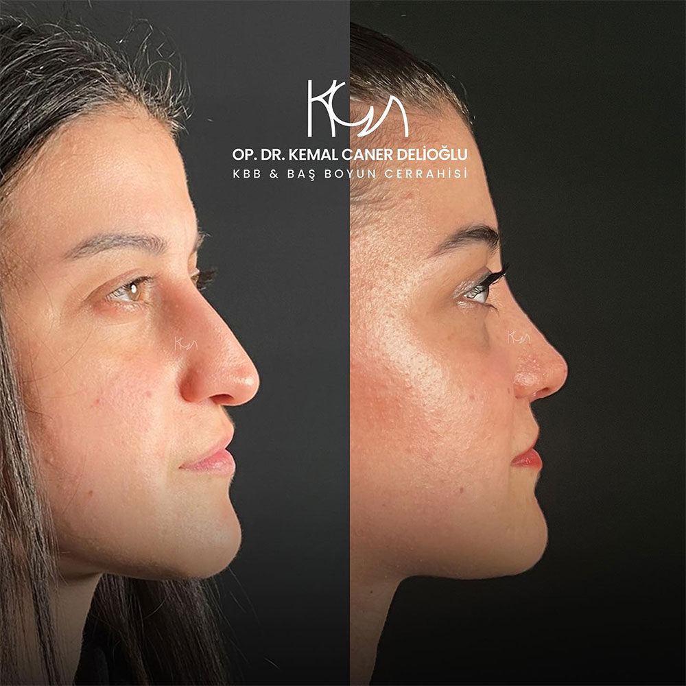 before-after